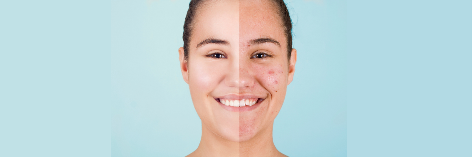 Adult Acne Solutions