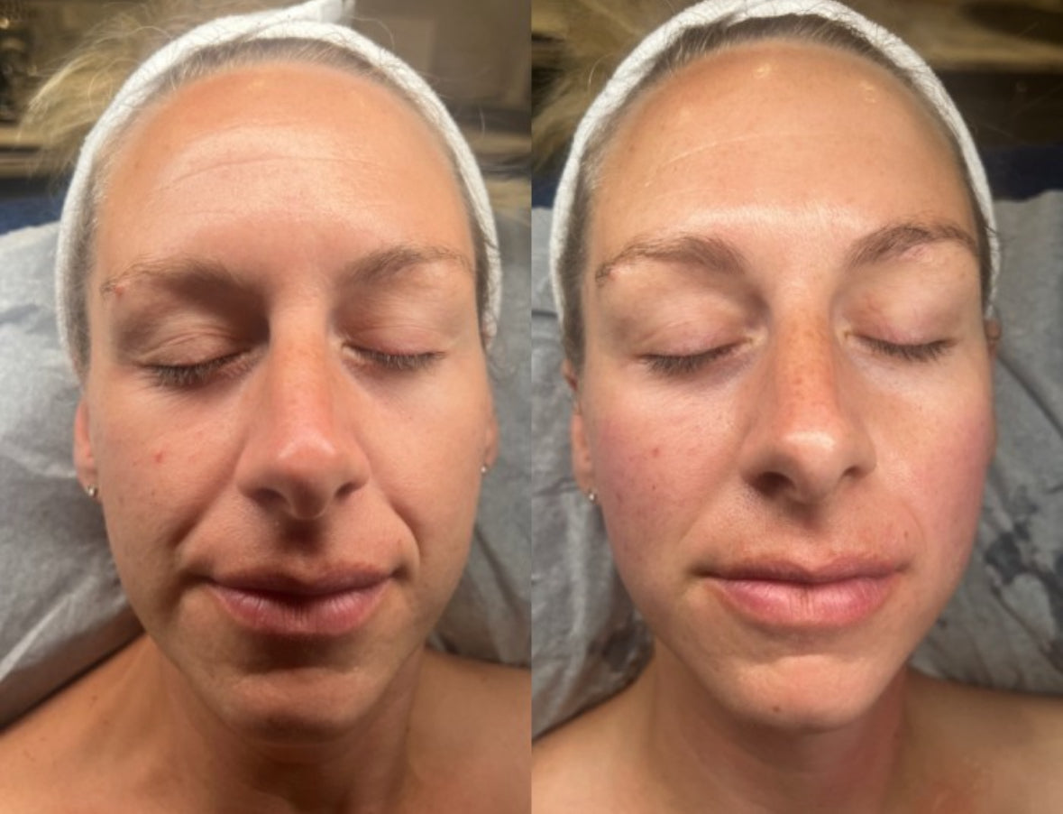 Buy 4 get 2 FREE Endymed Skin Tightening sessions