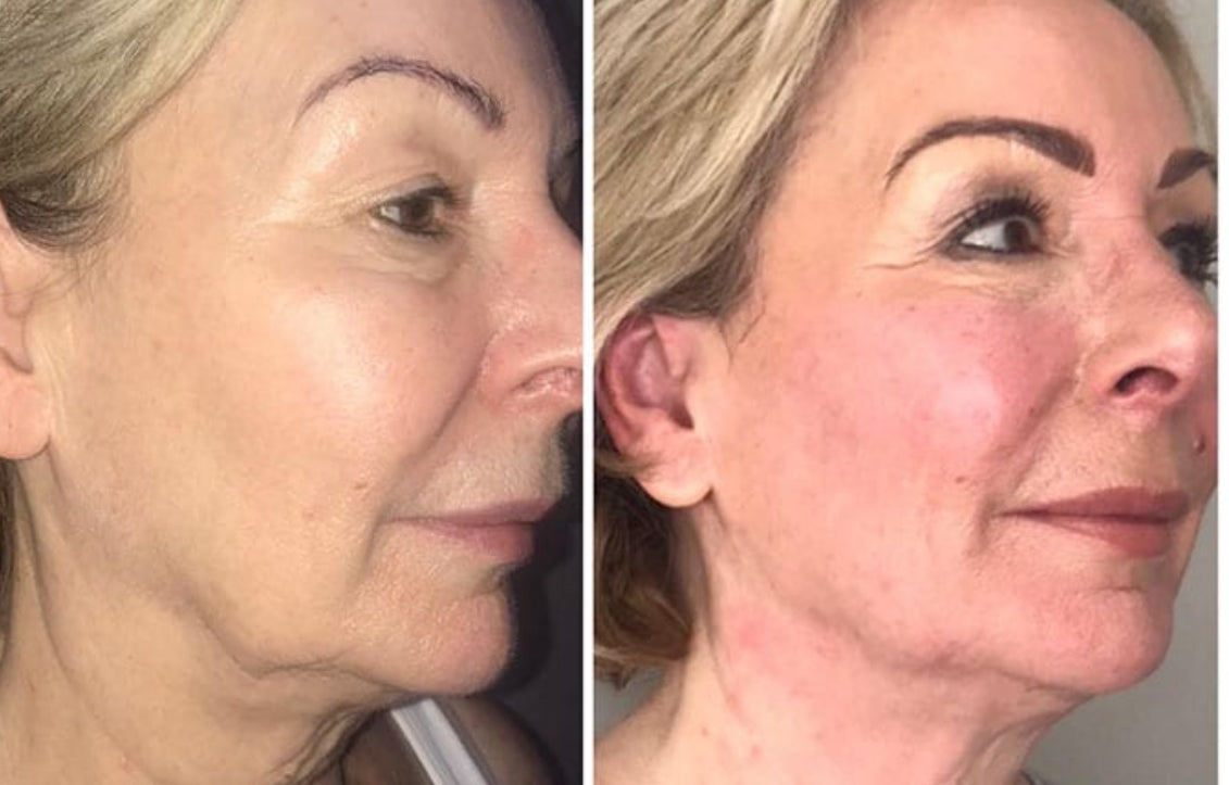 Buy 4 get 2 FREE Endymed Skin Tightening sessions
